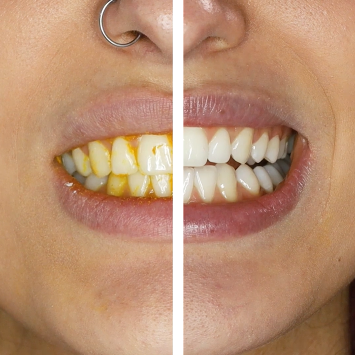 Teeth whitening beauty hack